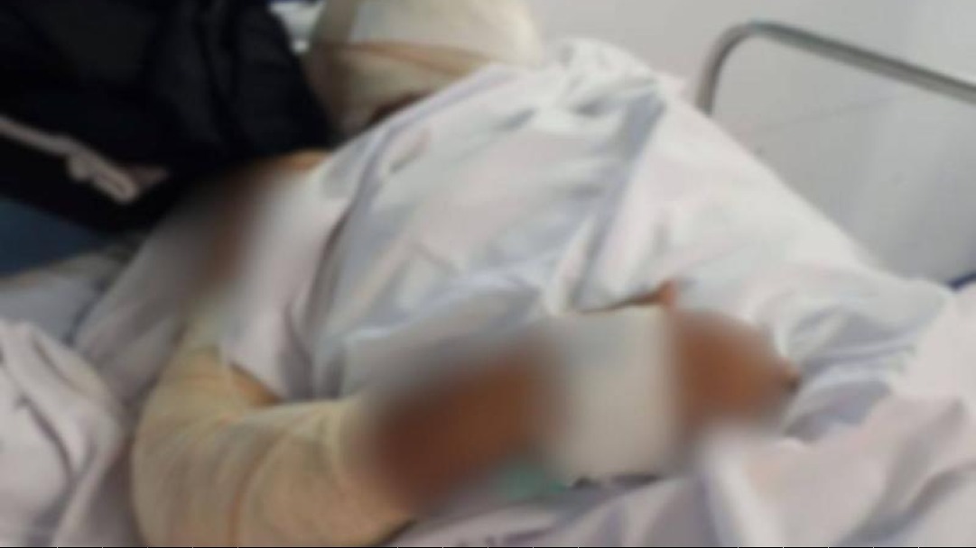 DESESPERO - Homem ateia fogo ao próprio corpo e é intubado em estado grave em Rondônia