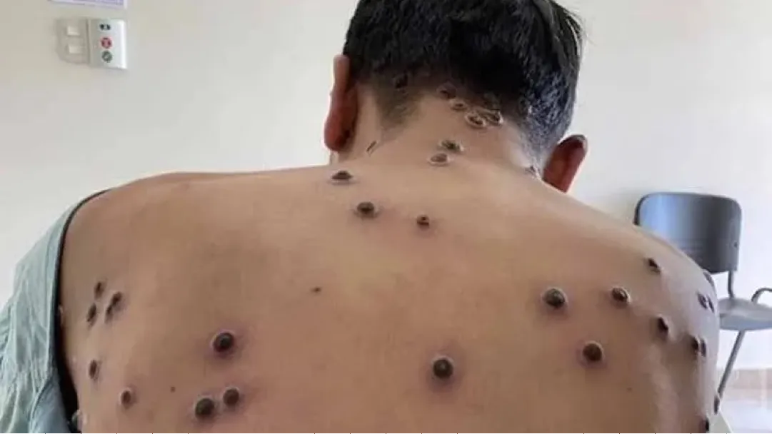 Sobe para quatro o número de casos confirmados de Mpox em Porto Velho