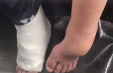 Adolescente autista fratura pé esquerdo e hospital engessa pé direito, em Vilhena, RO