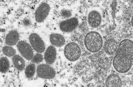 Brasil investiga dois casos suspeitos da varíola do macaco